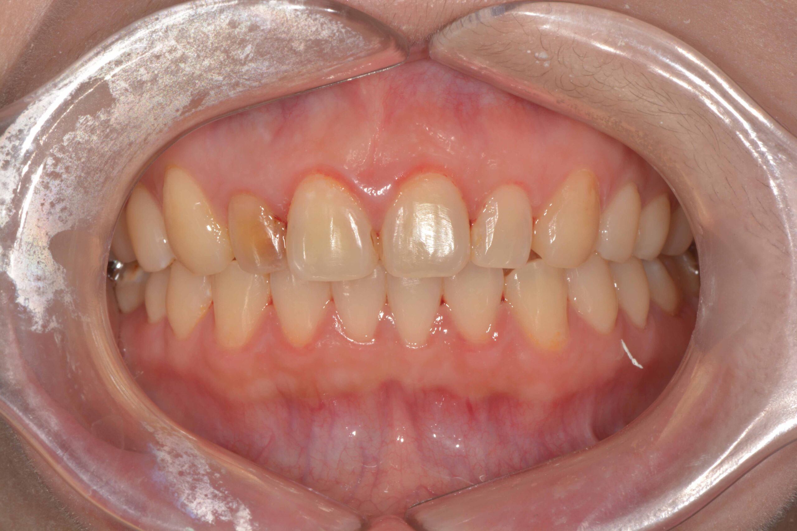 右側門牙因之前做根管治療，而變色變暗