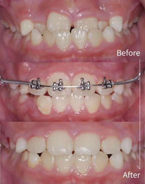 Pediatric orthodontics