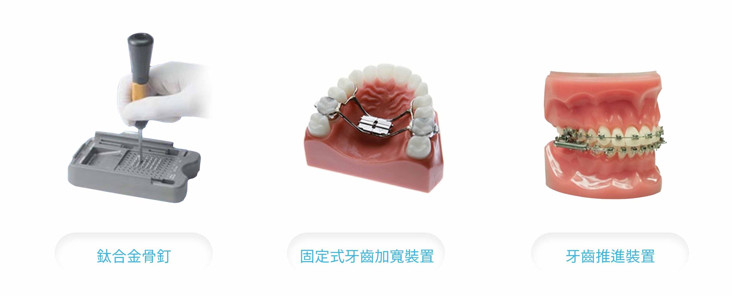 新竹牙齒矯正 矯正費用